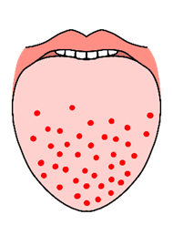 溶連菌感染症のアイキャッチ画像