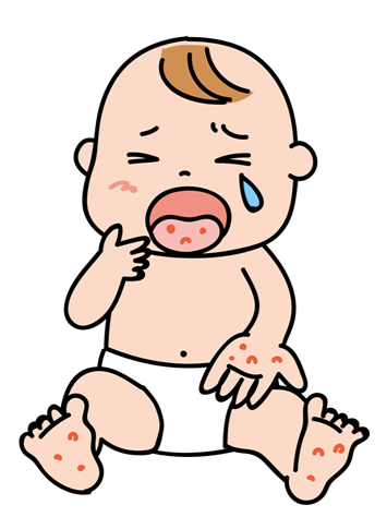 手足口病のアイキャッチ画像