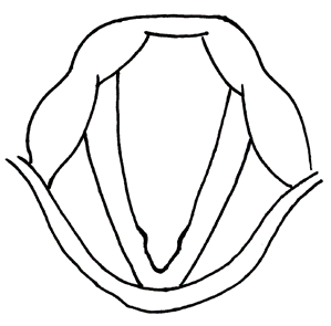 小児声帯結節のアイキャッチ画像