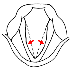 声帯萎縮症のアイキャッチ画像