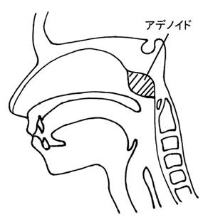 アデノイド肥大のアイキャッチ画像